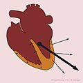 Hartas2 (CardioNetworks ECGpedia).jpg