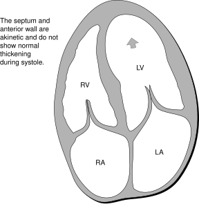 File:Heart a4c myocardial infraction.svg