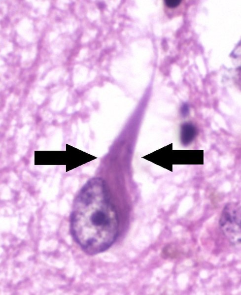 File:Histopathology of neurofibrillary tangles in Alzheimer's disease - annotated.jpg