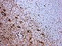 МС демијелинизација. CD68 обојено ткиво показује неколико макрофага у подручју лезије. Оригинална скала 1:100