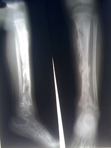 Ostermyelitt Tibia.jpg