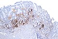 Type A gastritis (chromogranin immunostain), intermed. mag.