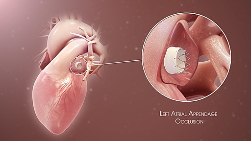 stroke symptoms - Watchman device 3D Medical Animation of Left Atrial Appendage Occlusion