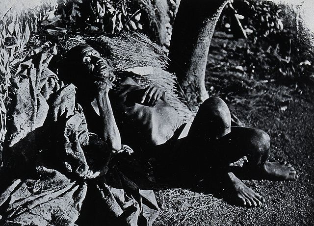A man having sleeping sickness at Buruma Island, Uganda.