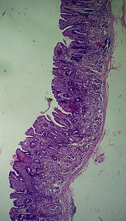 Миниатюра для Файл:Atrophic gastritis (low zoom).jpg