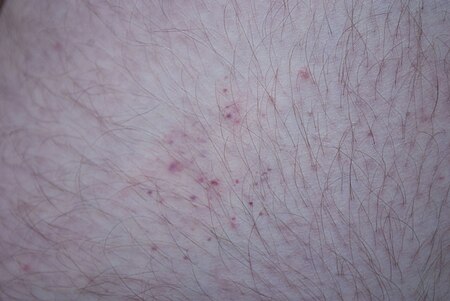 Fail:Bedbug bites on human thigh 2.jpg