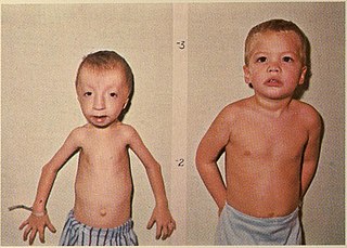 <span class="mw-page-title-main">Seckel syndrome</span> Medical condition