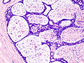 स्तन फाइब्रोएडीनोमा की हिस्टोपैथोलॉजिक छवि. कोर नीडल बायोप्सी. हेमटोक्सिलिन और एओसिन धब्बा.