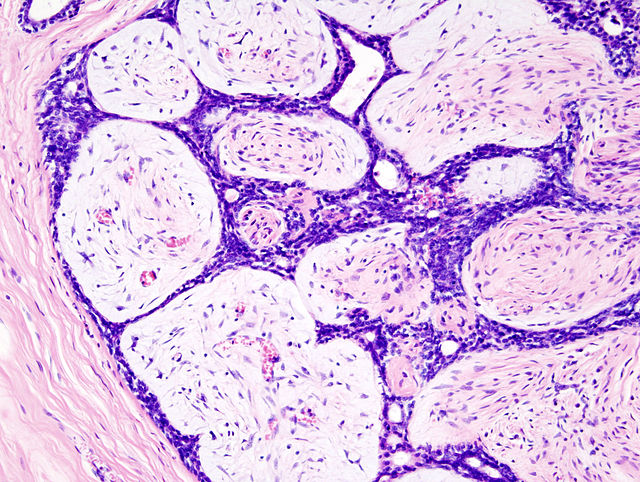 Description de l'image Breast fibradenoma (1).jpg.