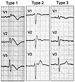 Les trois types de syndrome de Brugada