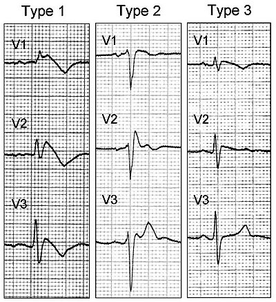 Syndrome De Brugada