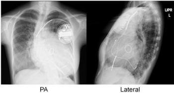 Chest radiographs of cardiac resynchronization therapy with defibrillator (CRT-D) in an individual with dilated cardiomyopathy after mitral valve replacement (MVR). The leads are:
- Atrial lead at the right appendage
- Right ventricular lead at the apex
- Left ventricular lead through the coronary sinus. CRT in dilated cardiomyopathy and mitral valve replacement.png