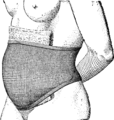 Fig. 107. — Ceinture abdominale, par Lacroix