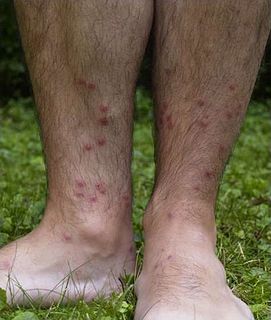 Swimmers itch Medical condition