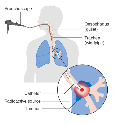 Brachytherapy (internal radiotherapy) for lung cancer given via the airway