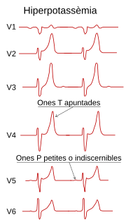 Miniatura per Hiperpotassèmia