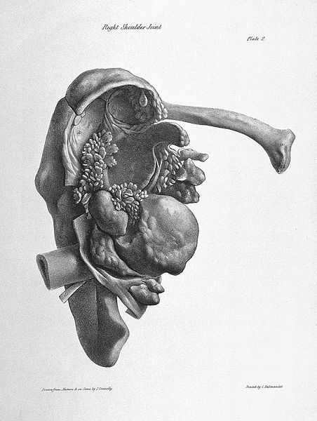 File:Effects of chronic rheumatic arthritis. Wellcome L0024125.jpg