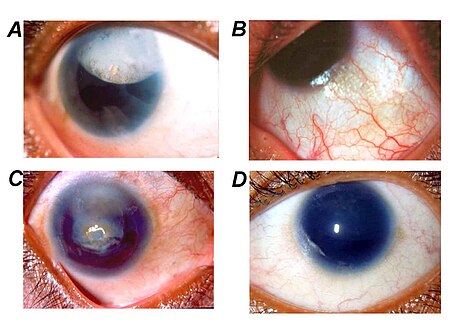 Fail:Human_eyeball_with_phenotypic_expression_of_aniridia_with_PAX6_gene_mutation.jpg