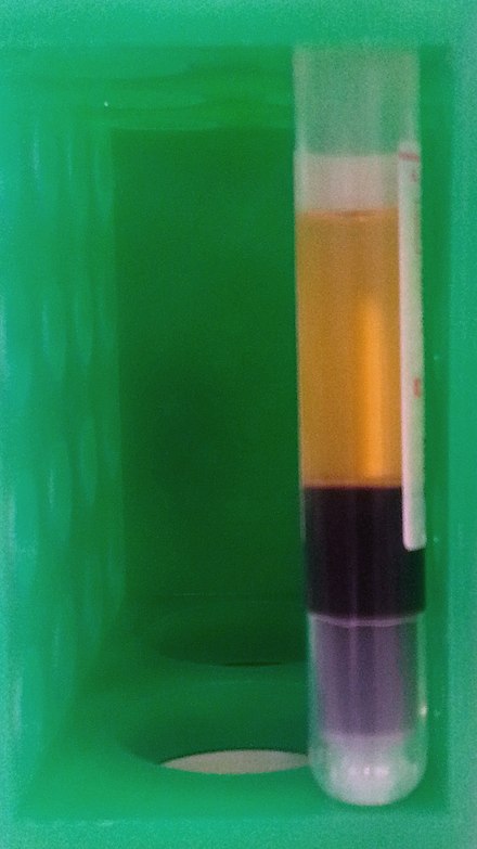 Sangue humano fraccionado por centrifugación. Plasma (parte superior, capa amarela), tampón (no medio, capa branca delgada) e capa de eritrocitos (no fondo, capa vermella).