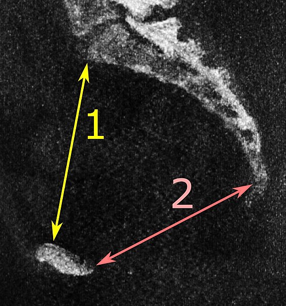 File:Low-dose CT of obstetric conjugate and pelvic outlet.jpg