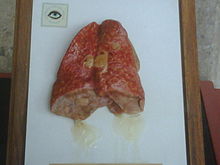 https://upload.wikimedia.org/wikipedia/commons/thumb/5/5a/Lungs_with_tuberculosis.jpg/220px-Lungs_with_tuberculosis.jpg