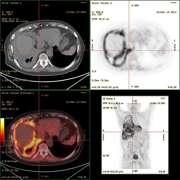 papillary renal cell carcinoma recurrence