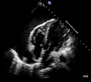 Pericardial effusion with tamponade (cropped).gif