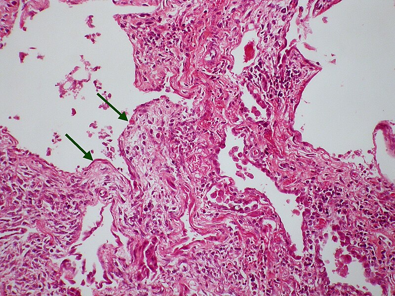 File:Scleroderma - UIP Case 221 (7326470104).jpg