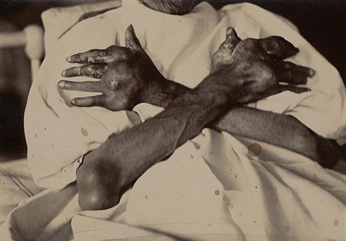 Black-and-white photograph of the arms and hands of a 50-years old man, showing large tophi of sodium urate affecting the elbow, knuckles, and finger joints.
