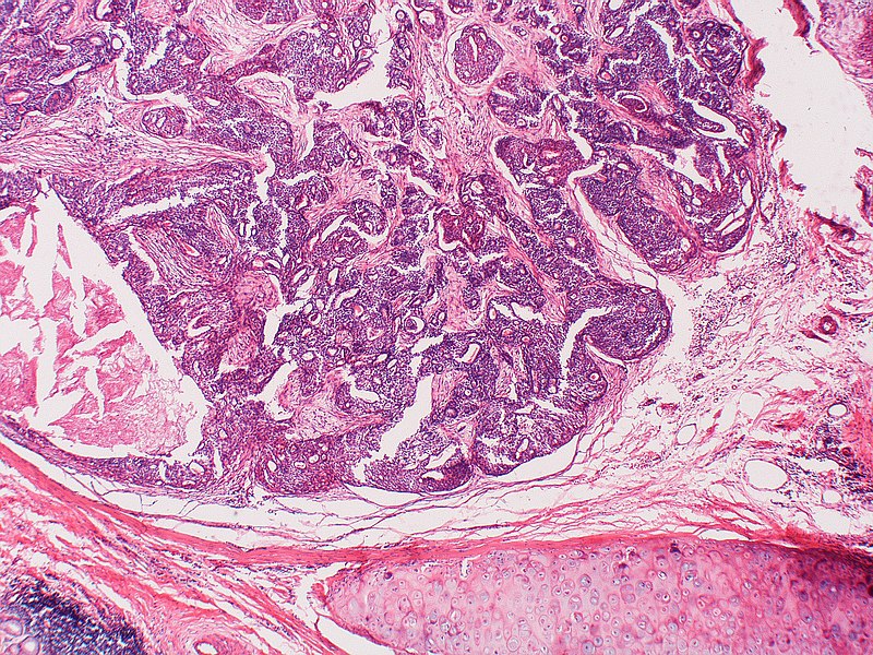 File:Typical carcinoid tumor (5020216730).jpg