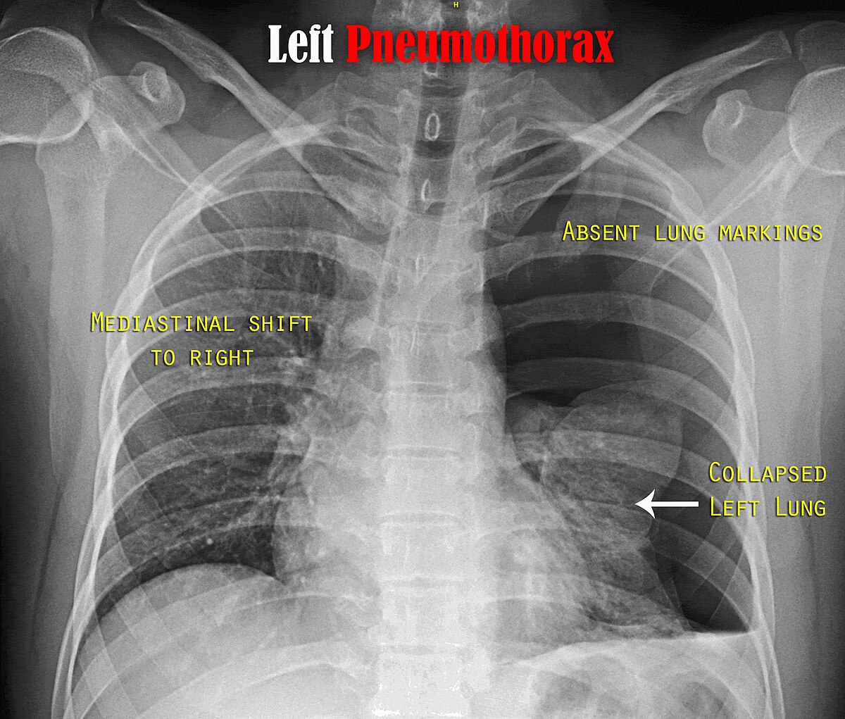 pneumothorax lung x ray