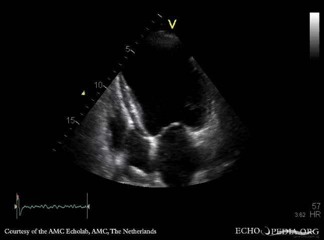 File:Apical aneurysm of LV E00283 (CardioNetworks ECHOpedia).webm - Wikimedia Commons