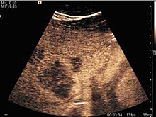 Peripheral vascular pattern of the lesion is observed in colon cancer metastasis (CEUS). Contrast-enhanced ultrasound of colon cancer metastasis in the liver.jpg