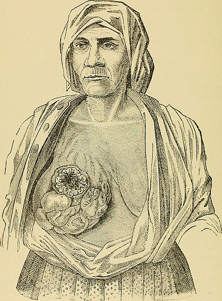 File:Cyclopædia of obstetrics and gynecology (1887) (14598162768).jpg