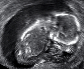 A 13-week fetus without cardiac activity located in the uterus (delayed or missed miscarriage)