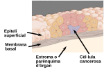 Miniatura per Carcinoma in situ