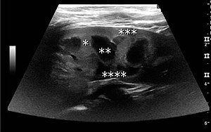 Figure 2. Normal pediatric kidney. * Column of Bertin; ** pyramid; *** cortex; **** sinus.※