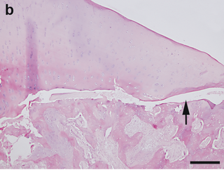 Osteochondritis dissecans pathology Danish sow.png