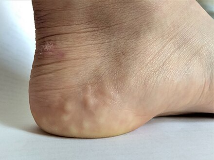 Piezogenic papules on the heel of an individual with Ehlers-Danlos syndrome. Piezogenic papules.jpg