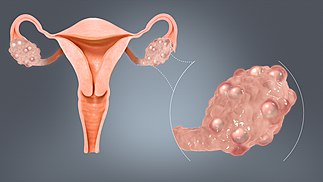 Ovary Wikipedia