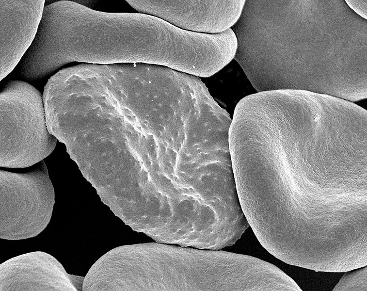 File:Red blood cells infected with malaria.jpg