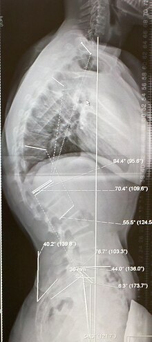 A 20-year-old male with Scheuermann's disease, showing various measurement of kyphotic/lordotic degrees and their supplementary angles. Notice the signature 'wedging' shape of the four vertebrae in the lower thoracic area. The other vertebral bodies are otherwise normal. The measured kyphosis for this patient is ~70deg. Scheuermanns70.jpg