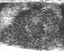 Fig. 7. Lymphoma. Lymphoma in a 61-year-old man. Longitudinal sonography shows an irregular hypoechoic lesion occupied nearly the whole testis. Scrotal ultrasonography of lymphoma.jpg