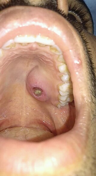 <span class="mw-page-title-main">Necrotizing sialometaplasia</span> Medical condition