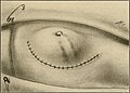 The breast- its anomalies, its diseases, and their treatment (1917) (14754695134).jpg