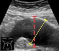 Ultrasonography in the sagittal plane, showing axial plane measure (dashed red line), as well as maximal diameter (dotted yellow line), which is preferred