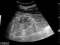 Chronic renal disease caused by glomerulonephritis with increased echogenicity and reduced cortical thickness. Measurement of kidney length on the US image is illustrated by '+' and a dashed line.[48]