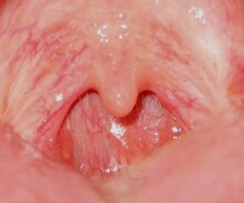 Throat some days after a tonsillectomy. Uvula without tonsils.jpg