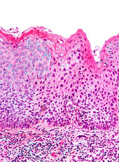 Vulvar intraepithelial neoplasia Medical condition