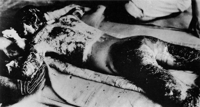 File:An atomic bomb victim with whole body burned - 1 - Ninoshima Quarantine Office - 7 August 1945 - Onuka Masami.png